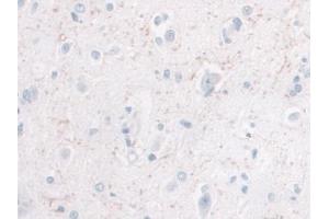 DAB staining on IHC-P; Samples: Human Glioma Tissue) (IL-10 anticorps  (AA 1-178))