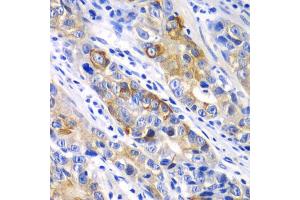 Immunohistochemistry of paraffin-embedded human gastric cancer using BCL2 antibody (ABIN5970041) at dilution of 1/100 (40x lens). (Bcl-2 anticorps)