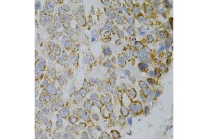 Immunohistochemistry of paraffin-embedded human esophageal cancer using GNAO1 Antibody. (GNAO1 anticorps)