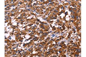 The image on the left is immunohistochemistry of paraffin-embedded Human thyroid cancer tissue using ABIN7129993(KIR2DL3/KIR2DL1/KIR2DL4/KIR2DS4 Antibody) at dilution 1/30, on the right is treated with fusion protein. (KIR2DL3/KIR2DL1/KIR2DL4/KIR2DS4 anticorps)