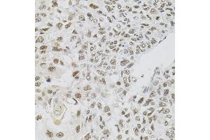 Immunohistochemistry of paraffin-embedded human lung cancer using FAF1 antibody (ABIN5975642) (40x lens). (FAF1 anticorps)