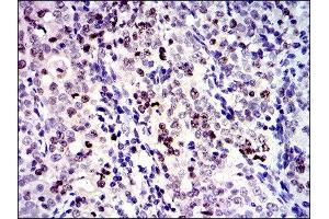 Immunohistochemistry (IHC) image for anti-Baculoviral IAP Repeat-Containing 5 (BIRC5) antibody (ABIN1845166) (Survivin anticorps)