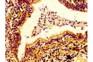 IHC image of ABIN7151695 diluted at 1:100 and staining in paraffin-embedded human lung cancer performed on a Leica BondTM system. (ERGIC2 anticorps  (AA 55-310))