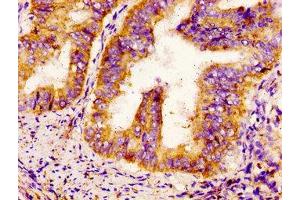 IHC image of ABIN7169929 diluted at 1:300 and staining in paraffin-embedded human endometrial cancer performed on a Leica BondTM system. (SCN9A anticorps  (AA 1849-1988))