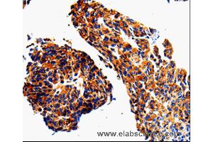 Immunohistochemistry of Human lung cancer using ADD1 Polyclonal Antibody at dilution of 1:50 (alpha Adducin anticorps)
