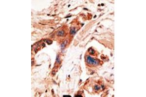 Formalin-fixed and paraffin-embedded human cancer tissue reacted with the primary antibody, which was peroxidase-conjugated to the secondary antibody, followed by AEC staining. (BMP2K anticorps  (AA 260-291))