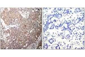 Immunohistochemical analysis of paraffin-embedded human breast carcinoma tissue using Keratin 18 (Ab-33) antibody (E021306). (Cytokeratin 18 anticorps)