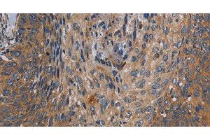 Immunohistochemistry of paraffin-embedded Human cervical cancer tissue using PARP10 Polyclonal Antibody at dilution 1:30 (PARP10 anticorps)