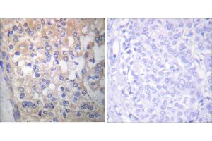 P-peptide - +Immunohistochemical analysis of paraffin-embedded human breast carcinoma tissue using Fyn (Phospho-Tyr530) antibody (#A0430). (FYN anticorps  (pTyr530))