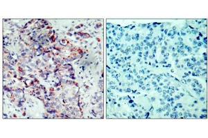 Immunohistochemical analysis of paraffin-embedded human breast carcinoma tissue, using SEK1/MKK4 (phospho-Ser80) antibody (E011177). (MAP2K4 anticorps  (pSer80))