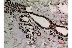 Immunohistochemistry (IHC) analysis of paraffin-embedded Human Breast Cancer, antibody was diluted at 1:100. (Histone 3 anticorps  (2meLys10))