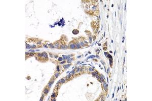 Immunohistochemistry of paraffin-embedded human stomach cancer using FABP3 antibody (ABIN5973057) at dilution of 1/200 (40x lens). (FABP3 anticorps)