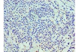 Immunohistochemistry of paraffin-embedded human breast cancer using ABIN7155973 at dilution of 1:100 (HYAL3 anticorps  (AA 198-417))