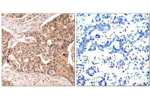 Immunohistochemical analysis of paraffin-embedded human breast carcinoma tissue using Paxillin (phospho-Tyr118) antibody (E011089). (Paxillin anticorps  (pTyr118))