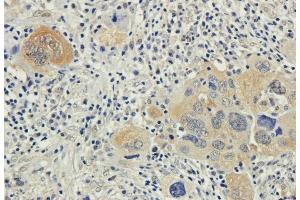 Immunohistochemical staining of human lung cancer using anti-Bax antibody. (Recombinant Bax (Active Monomer) (AA 12-24), (AA 3-16) anticorps)