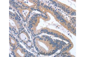 Immunohistochemistry of Human lymphoma using GDF11 Polyclonal Antibody at dilution of 1:30 (GDF11 anticorps)