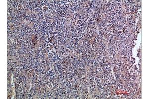 Immunohistochemical analysis of paraffin-embedded human-kidney-cancer, antibody was diluted at 1:200. (EGF anticorps  (AA 1000-1060))