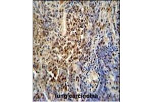 PUS3 antibody (N-term) (ABIN654789 and ABIN2844467) immunohistochemistry analysis in formalin fixed and paraffin embedded human lung carcinoma followed by peroxidase conjugation of the secondary antibody and DAB staining. (PUS3 anticorps  (N-Term))