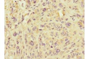 Immunohistochemistry of paraffin-embedded human melanoma using ABIN7159921 at dilution of 1:100 (IMMP2L anticorps  (AA 1-100))