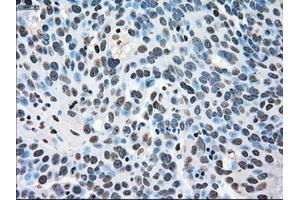 Immunohistochemical staining of paraffin-embedded Adenocarcinoma of breast tissue using anti-MAPK1 mouse monoclonal antibody. (ERK2 anticorps)