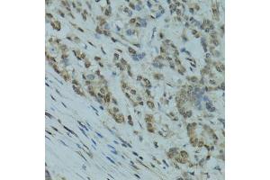 Immunohistochemistry of paraffin-embedded human colon carcinoma using GABPA antibody. (GABPA anticorps)
