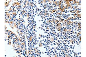 The image on the left is immunohistochemistry of paraffin-embedded Human tonsil tissue using ABIN7191316(LRP1 Antibody) at dilution 1/90, on the right is treated with synthetic peptide. (LRP1 anticorps)