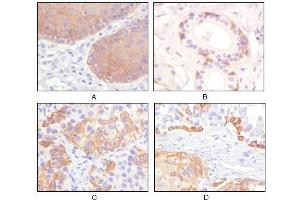 Immunohistochemical analysis of paraffin-embedded human esophagus epithelium (A), salivary gland basal cell (B), lung squamous cell carcinoma (C), endometrium admosquamous carcinoma (D), showing cytoplasmic and membrane localization using CK5 antibody with DAB staining. (Cytokeratin 5 anticorps)