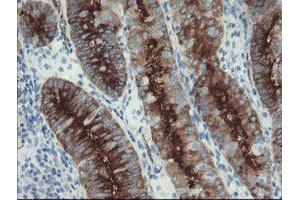 Immunohistochemical staining of paraffin-embedded Adenocarcinoma of Human endometrium tissue using anti-FOLH1 mouse monoclonal antibody. (PSMA anticorps)