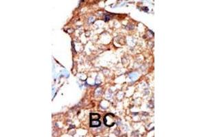 Formalin-fixed and paraffin-embedded human cancer tissue reacted with the primary antibody, which was peroxidase-conjugated to the secondary antibody, followed by DAB staining. (ZAP70 anticorps  (AA 252-282))