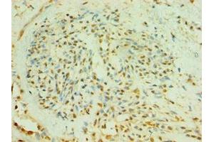 Immunohistochemistry of paraffin-embedded human breast cancer using ABIN7174009 at dilution of 1:100 (BLK anticorps  (AA 1-280))