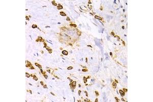 Immunohistochemistry of paraffin-embedded human gastric cancer using KRT15 antibody. (KRT15 anticorps)