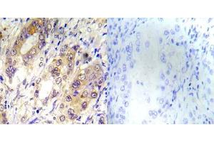 Immunohistochemical analysis of paraffin-embedded human lung carcinoma tissue using Tsc2 (phospho-Thr1462) antibody (E012050). (Tuberin anticorps  (pThr1462))