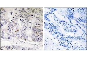 Immunohistochemistry analysis of paraffin-embedded human colon carcinoma tissue, using UBTD1 Antibody. (UBTD1 anticorps  (AA 151-200))