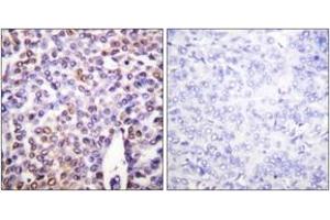 Immunohistochemistry analysis of paraffin-embedded human breast carcinoma tissue, using Histone H4 (Ab-16) Antibody. (Histone H4 anticorps  (AA 15-64))