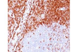 IHC testing of formalin-paraffin non-Hodgkin's lymphoma stained with Bcl-2 antibody (100/D5). (Bcl-2 anticorps)