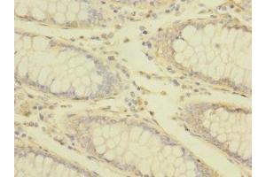 Immunohistochemistry of paraffin-embedded human colon cancer using ABIN7172869 at dilution of 1:100 (TRPM7 anticorps  (AA 756-855))