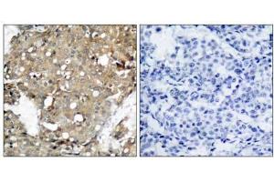 Immunohistochemical analysis of paraffin-embedded human breast carcinoma tissue using STAT1 (Ab-727) antibody (E021177). (STAT1 anticorps)