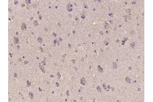 Paraformaldehyde-fixed, paraffin embedded Human brain glioma Antigen retrieval by boiling in sodium citrate buffer (pH6. (IDH1 anticorps  (AA 70-115))