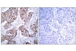 Immunohistochemical analysis of paraffin- embedded human breast carcinoma tissue using (EGFR anticorps  (pTyr1092))