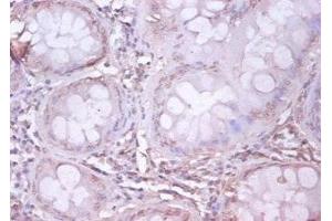 Immunohistochemistry of paraffin-embedded human colon cancer using ABIN7144046 at dilution of 1:100 (APP anticorps  (AA 18-664))