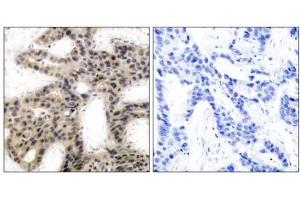 Immunohistochemical analysis of paraffin-embedded human breast carcinoma tissue using 4E-BP1 (phospho-Thr45) antibody (E011223). (eIF4EBP1 anticorps  (pThr45))
