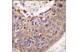 Formalin-fixed and paraffin-embedded human lung carcinoma tissue reacted with FXN antibody (C-term), which was peroxidase-conjugated to the secondary antibody, followed by DAB staining. (Frataxin anticorps  (C-Term))