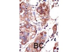 Formalin-fixed and paraffin-embedded human cancer tissue reacted with the primary antibody, which was peroxidase-conjugated to the secondary antibody, followed by AEC staining. (MUSK anticorps  (C-Term))