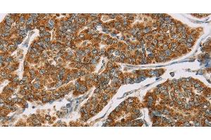 Immunohistochemistry of paraffin-embedded Human breast cancer tissue using DLL4 Polyclonal Antibody at dilution 1:40 (DLL4 anticorps)