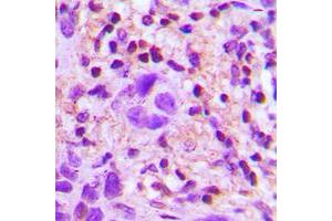 Immunohistochemical analysis of TGF beta 2 staining in human lung cancer formalin fixed paraffin embedded tissue section. (TGFB2 anticorps  (C-Term))