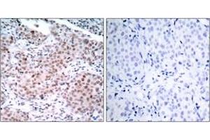 Immunohistochemistry analysis of paraffin-embedded human breast carcinoma, using Estrogen Receptor-alpha (Phospho-Ser104) Antibody. (Estrogen Receptor alpha anticorps  (pSer104))