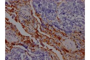 IHC image of ABIN7127559 diluted at 1:100 and staining in paraffin-embedded human lung cancer performed on a Leica BondTM system. (Recombinant ICAM1 anticorps)