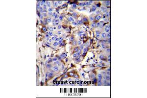 GCDFP-15 Antibody immunohistochemistry analysis in formalin fixed and paraffin embedded human breast carcinoma followed by peroxidase conjugation of the secondary antibody and DAB staining. (PIP anticorps  (C-Term))