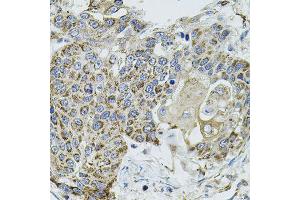 Immunohistochemistry of paraffin-embedded human lung cancer using VEPH1 antibody (ABIN5974616) (40x lens). (VEPH1 anticorps)