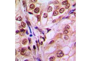 Immunohistochemical analysis of 4EBP1 staining in human breast cancer formalin fixed paraffin embedded tissue section. (eIF4EBP1 anticorps  (Center))